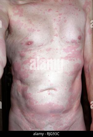 L'uomo, 68 anni, con reazioni allergiche, rash cutaneo, allergia, di repellente per insetti Baygon, Indonesia Foto Stock