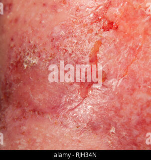 Neurodermatite acuta rispettivamente eczema atopico Foto Stock