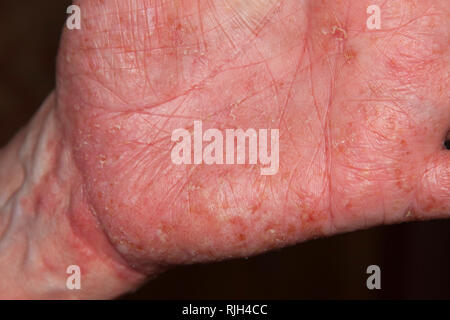 Neurodermatite acuta rispettivamente eczema atopico Foto Stock