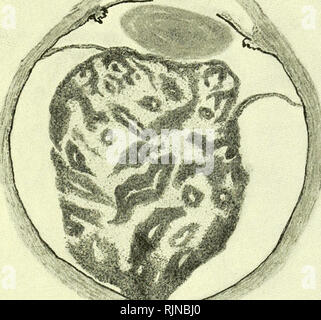 . La patologia e batteriologia [risorsa elettronica]. Oftalmologia; occhio; occhio; batteriologia; oftalmologia; occhio; batteriologia; occhio. GLIOMA O NEURO-EPITHELIOMA DELLA RETINA 175 degeneri e undegenerate parti della crescita. I nuclei delle cellule in questi ultimi la colorazione profondamente e quelli dell'ex molto poco o affatto (Fig. 85). La proliferazione delle cellule della crescita appare a procedere ad una velocità che è fuori di proporzione alla rapidità di aumento della sua canali vascolari; in modo tale che le superfici in esso essere- venire mal nutriti e subiscono una degenerazione. L. Fig. 85.-sezione attraverso un Foto Stock