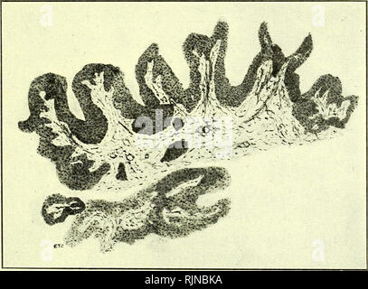 . La patologia e batteriologia [risorsa elettronica]. Oftalmologia; occhio; occhio; batteriologia; oftalmologia; occhio; batteriologia; occhio. PAPILLOMA In un epithelioma, oltre a cellule di origine epiblastic, polimorfonucleate, leucociti mononucleati e endothe- lial cellule sono soddisfatte con. La leucocitosi è senza dubbio eccitato da organismi pyogenic dalla superficie, ed è più marcato quando ulcerazione ha avuto luogo. La pro- liferating cellule endoteliali attorno alla crescita assomigliare strettamente le celle della crescita stessa, per cui essi sono suscettibili di essere confusi. Quando l'organizzazione avviene, bande di fib Foto Stock