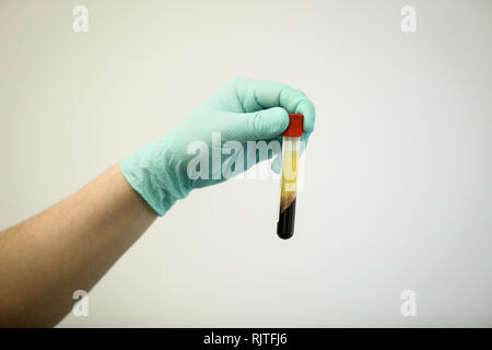 Dettagli con la mano di un medico, indossando di gomma Guanti chirurgici e tenendo un flaconcino di plasma di sangue estratto dal sangue per centrifugazione Foto Stock
