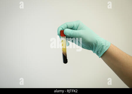 Dettagli con la mano di un medico, indossando di gomma Guanti chirurgici e tenendo un flaconcino di plasma di sangue estratto dal sangue per centrifugazione Foto Stock