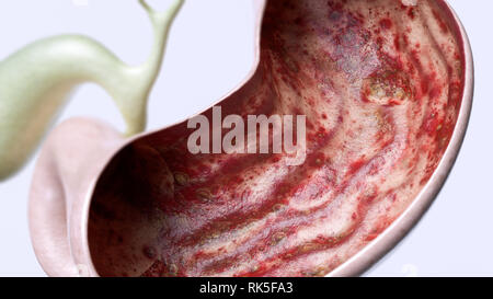 Ulcera di stomaco fase 3 di 3 - alto grado di dettaglio - il rendering 3D Foto Stock
