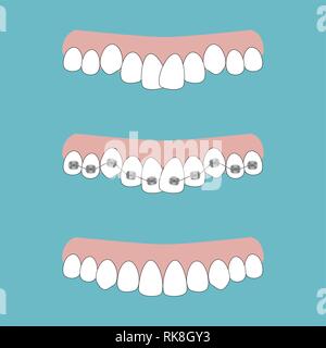 Illustrazione vettoriale delle fasi del trattamento ortodontico rinforzi su denti . Denti prima e dopo la parentesi graffe su . Sfondo in stile piatto Illustrazione Vettoriale