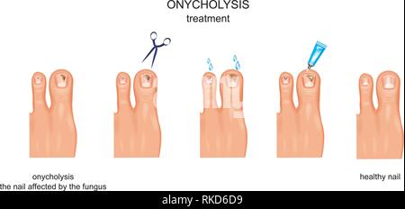 Illustrazione vettoriale di onycholysis, fungine infezione unghie, trattamento Illustrazione Vettoriale