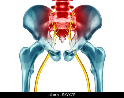 Sciatica dolore sintomi e diagnosi concetto medico come una malattia causando problemi fisici con 3D illustrazione elementi su uno sfondo bianco. Foto Stock