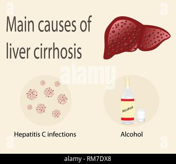 Principali cause di cirrosi epatica Infezione da virus dell epatite C e alcool illustrazione vettoriale infographics Illustrazione Vettoriale