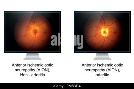 Ottica neuropatia ischemica medical illustrazione vettoriale Illustrazione Vettoriale