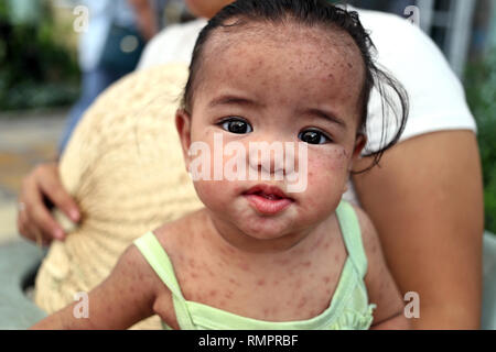 Manila, Filippine. 30 Novembre, 2018. Un bambino filippino affetti da morbillo è trattata in un ospedale. Il filippino le autorità sanitarie hanno lanciato una massiccia campagna di vaccinazione volti a vaccinare circa 2.000 bambini contro il morbillo ogni giorno. Il paese soffre di una grave epidemia di questa malattia. Credito: Alejandro Ernesto/dpa/Alamy Live News Foto Stock