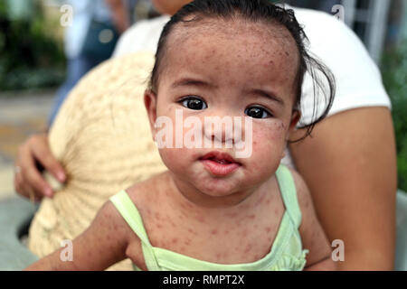 Manila, Filippine. 30 Novembre, 2018. Un bambino filippino affetti da morbillo è trattata in un ospedale. Il filippino le autorità sanitarie hanno lanciato una massiccia campagna di vaccinazione volti a vaccinare circa 2.000 bambini contro il morbillo ogni giorno. Il paese soffre di una grave epidemia di questa malattia. Credito: Alejandro Ernesto/dpa/Alamy Live News Foto Stock