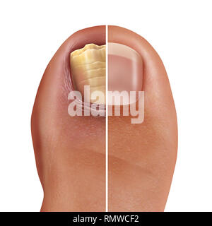 Infezioni fungine delle unghie e infezione onychomycosisor tinea unguium come un piede infetto toenail o punta chiodo con danni malsano e sano di anatomia umana. Foto Stock