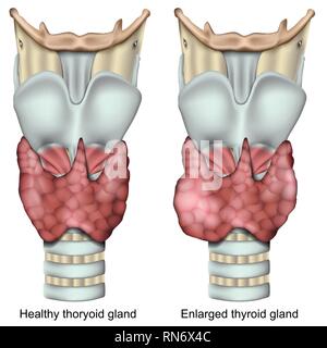 Ingrossamento della ghiandola tiroidea 3d medical illustrazione vettoriale isolati su sfondo bianco Illustrazione Vettoriale