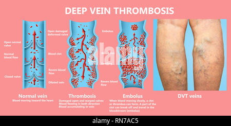 La trombosi venosa profonda o coaguli di sangue. Embolo. Foto Stock