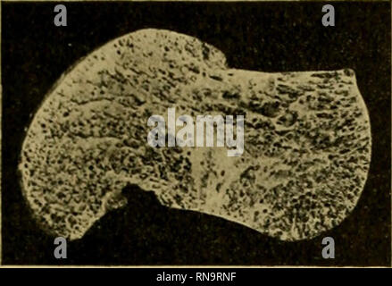 . Anatomische Hefte. Beitrag zur Kenntnis "1er Architektur spongiöser Knochen. 273 Rande des tief eingegrabenen solco tali mächtige Knochen- pfeiler nach aufwärts streben, von denen die vorderen nahe der Mitte der Knochenmasse derart bogenförmig nach vorne mit nach oben gerichteter Konvexität ablenken, dass sie gegen die obere und mittlere Partie des Kalmbeingelenkes verlaufen. Albert vergleicht diesen Teil der Knochenmasse mit einer Pi-. Fig. 44. Sagittalschnitt durch den astragalo.. Si prega di notare che queste immagini vengono estratte dalla pagina sottoposta a scansione di immagini che possono essere state migliorate digitalmente per ri Foto Stock