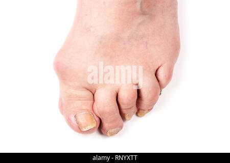 Poliartrite reumatoide a piedi isolato su sfondo bianco. Foto Stock