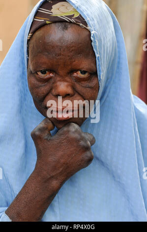 NIGER Maradi, lebbra colonia, donna soffre di lebbra / NIGER Maradi, Leprakolonie, Portraet einer Frau mit lepra Erkrankung Foto Stock