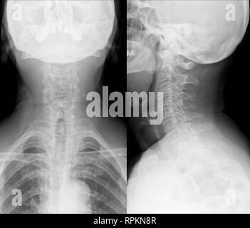 X-ray immagine medica - colonna cervicale e della testa Foto Stock