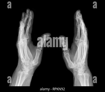 X-ray immagine medica - umani palms Foto Stock