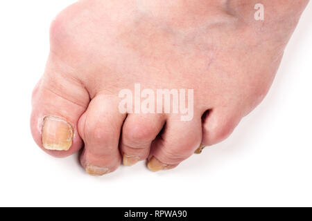 Poliartrite reumatoide a piedi isolato su sfondo bianco Foto Stock