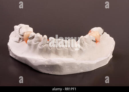 Calco in gesso di denti con rimovibile dentiera parziale su sfondo scuro Foto Stock