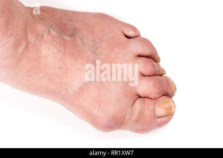 Poliartrite reumatoide a piedi isolato su sfondo bianco Foto Stock