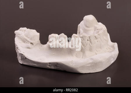 Calco in gesso di denti con rimovibile dentiera parziale su sfondo scuro Foto Stock