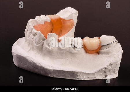 Calco in gesso di denti con rimovibile dentiera parziale su sfondo scuro Foto Stock