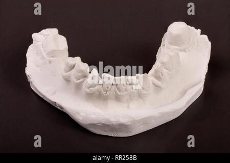 Calco in gesso di denti con rimovibile dentiera parziale su sfondo scuro Foto Stock