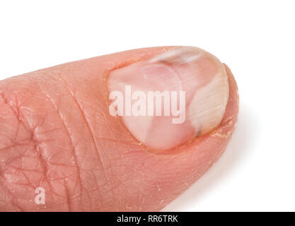 Un dito della mano con un fungo su chiodi isolato sfondo bianco Foto Stock