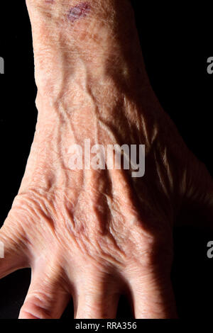 Dettaglio della mano e del polso di una donna anziana con un livido Foto Stock