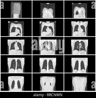 Scansione TC passo impostato del corpo del polmone vista coronale Foto Stock