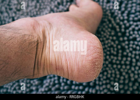 Secche e screpolate pelle sul tallone di un uomo caucasico Foto Stock