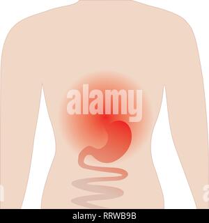 Gastrite. dolori di stomaco. Illustrazione Vettoriale su sfondo bianco Illustrazione Vettoriale