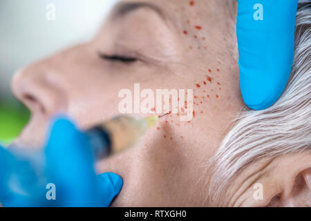 Il plasma ricco di piastrine del trattamento del viso. Close-up di donna matura la ricezione di plasma ricco di piastrine iniezioni per la riduzione delle rughe. Foto Stock