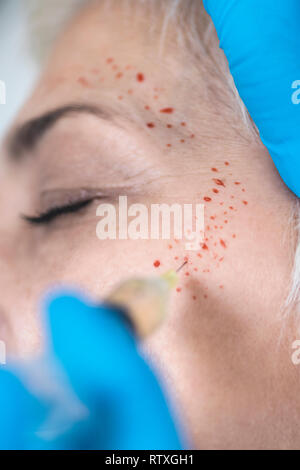 Il plasma ricco di piastrine del trattamento del viso. Close-up di donna matura la ricezione di plasma ricco di piastrine iniezioni per la riduzione delle rughe. Foto Stock