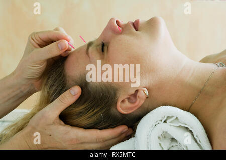 Donna in fase di agopuntura sul suo viso Foto Stock