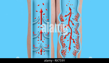 Vene varicose su una femmina senior gambe. La struttura del normale e di vene varicose. Concetto di pelle secca, antico popolo senior, vene varicose e profonda ve Foto Stock