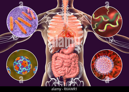 I batteri che causano infezioni umane, illustrazione Foto Stock