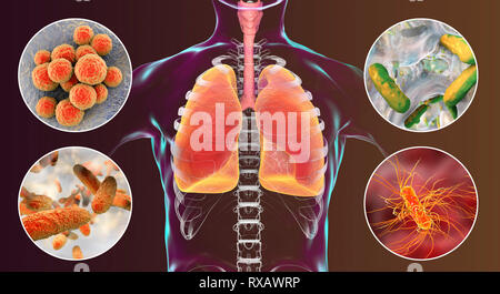 I batteri che causano la polmonite nosocomiale, illustrazione Foto Stock