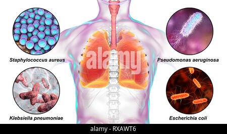 I batteri che causano la polmonite nosocomiale, illustrazione Foto Stock