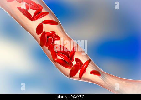 Vaso sanguigno bloccato in anemia falciforme, illustrazione Foto Stock