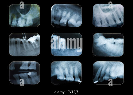 Esame dei denti, Multi dental pellicola a raggi x su sfondo nero. Foto Stock