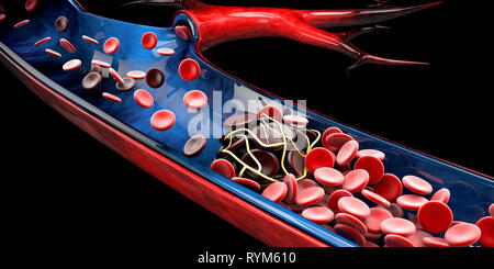 Anemia falciforme, mostrando il vaso sanguigno con il normale e deformated crescent. 3D illustrazione Foto Stock