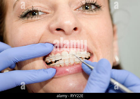 Ortodontista serrando le bretelle. Foto Stock