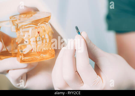 Dentista azienda impianto dentale e modello ganascia. Foto Stock
