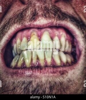 Male i denti Foto Stock