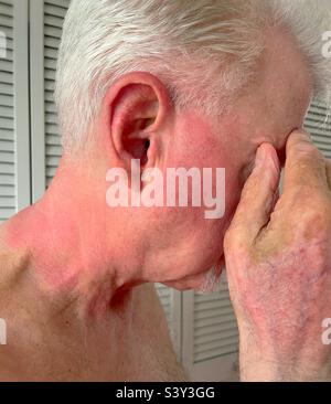Uomo caucasico anziano che soffre di scottature al collo e all'orecchio, 2022 Foto Stock