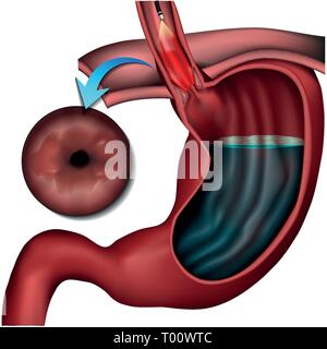 Barett esofago malattia medical illustrazione vettoriale su sfondo bianco Illustrazione Vettoriale