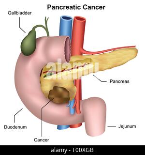 Il cancro pancreatico medical illustrazione vettoriale Illustrazione Vettoriale